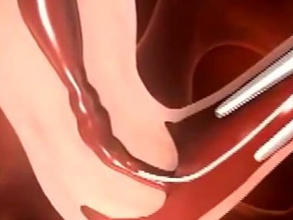 北医三院三代试管指南，附费用介绍